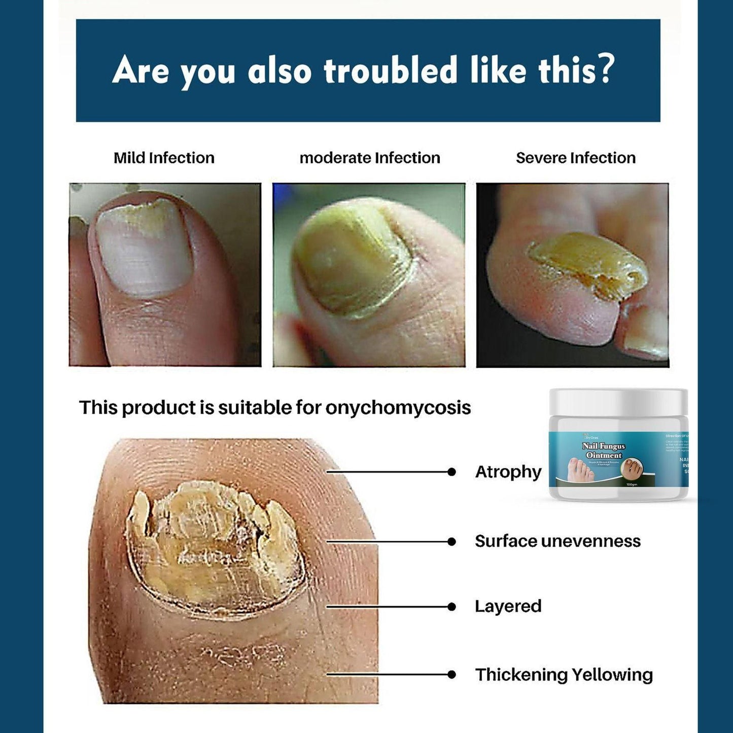 TryOnes Nail Fungus Ointment 100gram (Pack of 2)