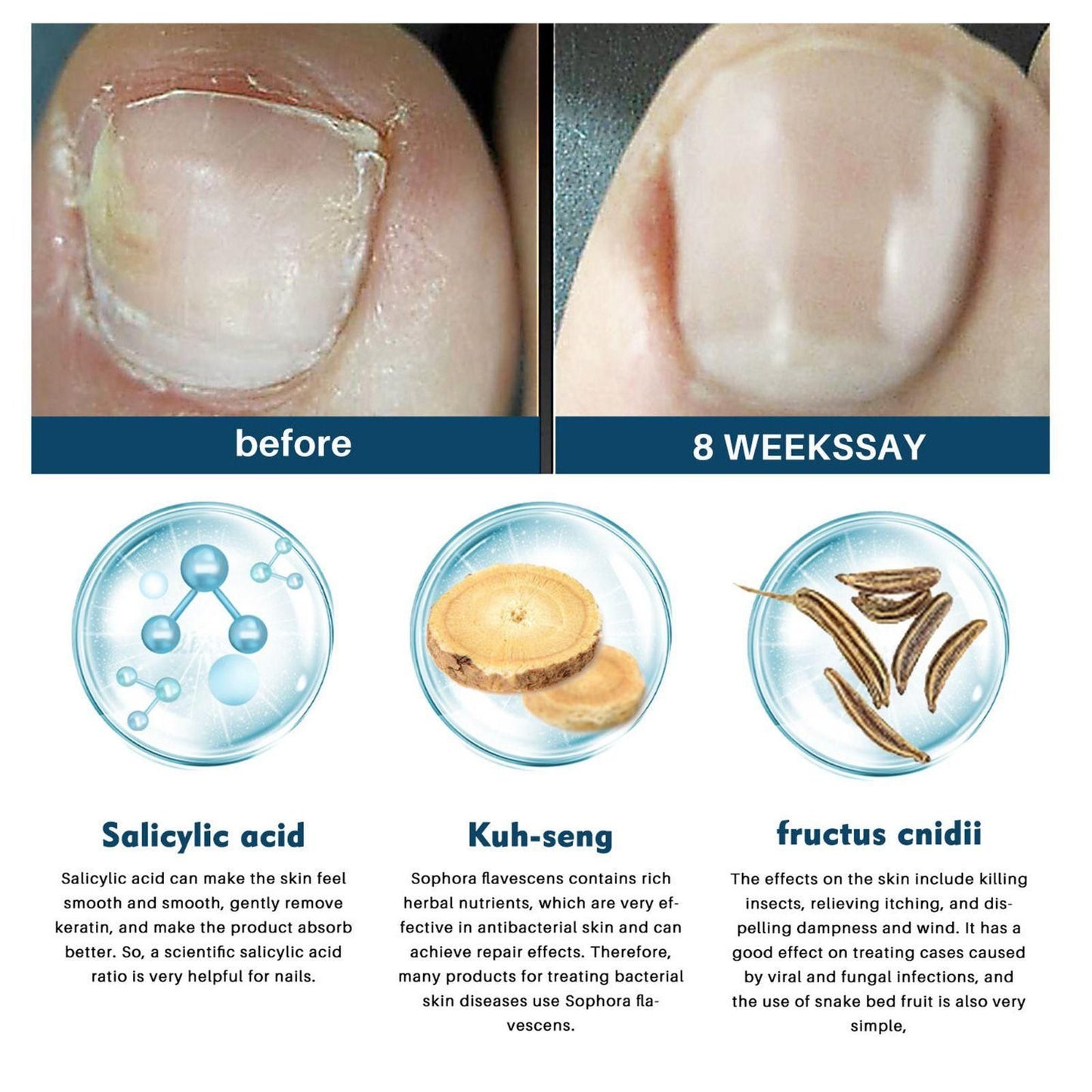 TryOnes Nail Fungus Ointment 100gram (Pack of 2)