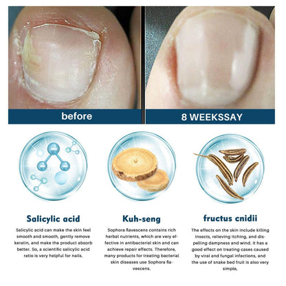 TryOnes Nail Fungus Ointment 100gram (Pack of 2)